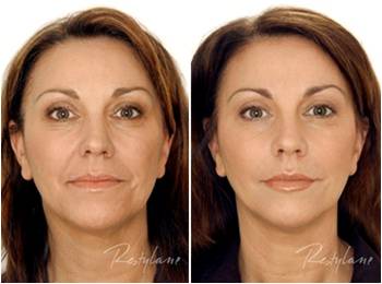 Restylane face